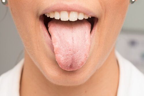 Nevoia de remedii naturale pentru limba albicioasă care ajută la curățarea gurii