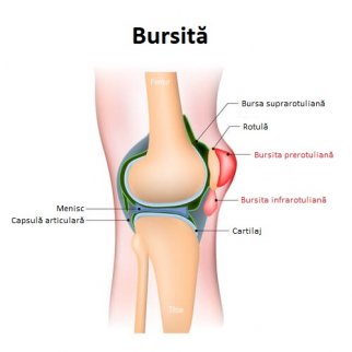 inflamația bursitei sacului articular)