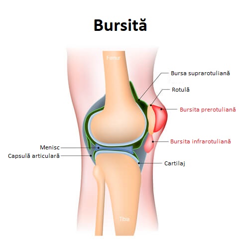 Tot ce trebuie să știi despre bursită și complicațiile ei