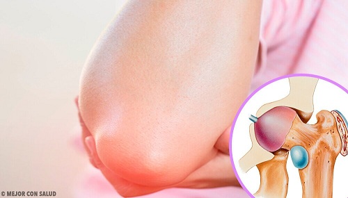 Ce este artroza patelofemorală a genunchiului alimente de evitat in guta