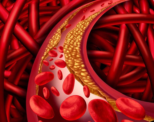 Arteră înfundată de alimente bogate în colesterol rău