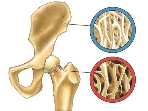 Fracturile osoase oferind informații esențiale despre osteoporoză