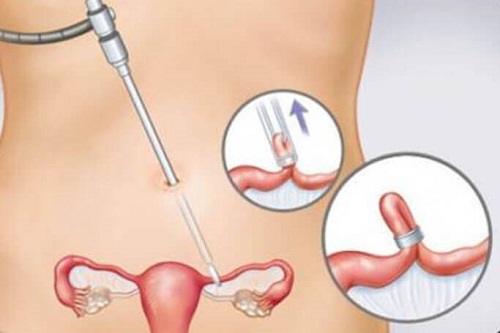 Medic care știe dacă renunțarea la contraceptive este vreodată necesară