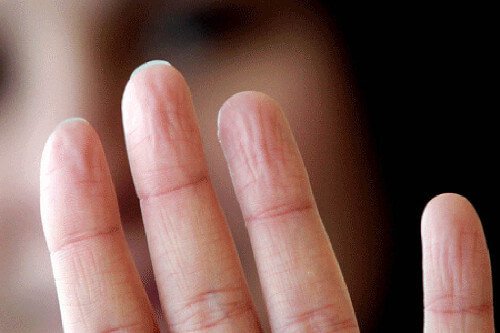 Probleme de sănătate indicate de mâini care transpiră excesiv