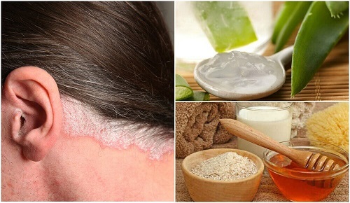 5 remedii naturale pentru psoriazisul scalpului