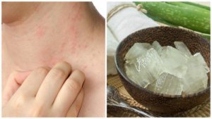 7 remedii pentru alergia la căldură