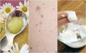 5 tratamente pentru a elimina negii plani