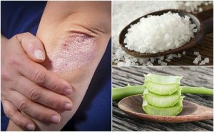 5 remedii naturiste pentru ciupercile pielii