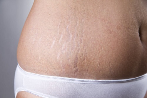 Întrebuințări ale capsulelor de vitamina E precum tratarea vergeturilor