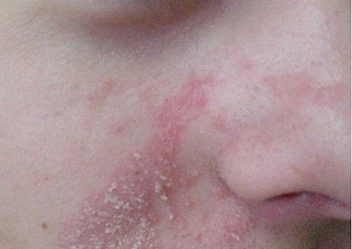 Pacient care are nevoie de remedii naturiste pentru dermatita seboreica