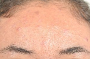 6 remedii naturiste pentru dermatita seboreică