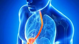 Cele mai bune remedii pentru refluxul gastroesofagian
