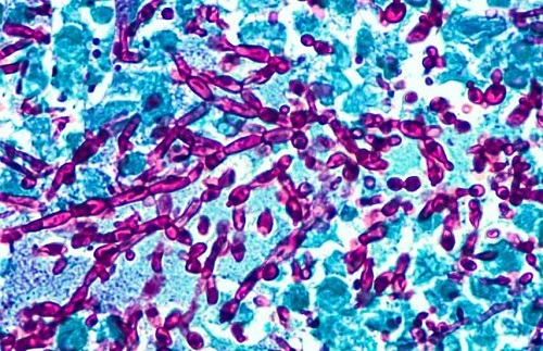 Tipuri de infecții vaginale, cum ar fi candidoza