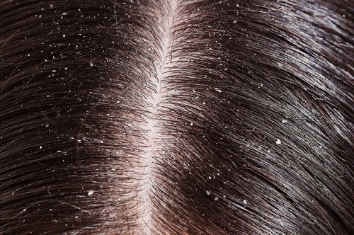 Beneficii ale rozmarinului pentru păr ce elimină mătreața