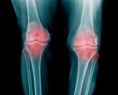 antiinflamatoare nesteroidiene pentru tratamentul articulației genunchiului îmbinare de perie de mână