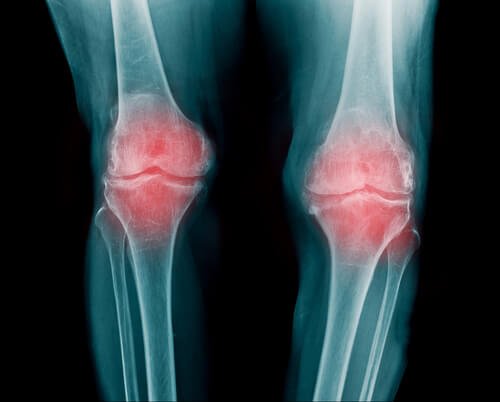 Cauzele furnicăturilor de la nivelul articulațiilor precum artrita reumatoidă 