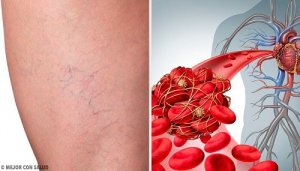 Cele mai bune 3 remedii naturale pentru flebită