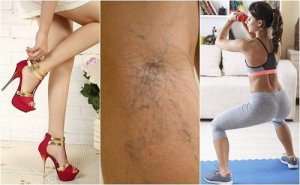 Descoperă 10 trucuri pentru a preveni varicele