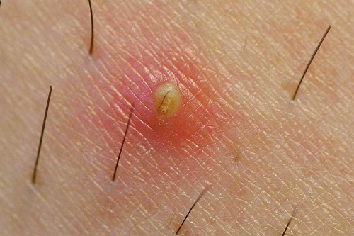 Inflamație produsă de firele de păr crescute sub piele