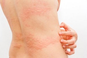Descoperă 3 remedii naturiste pentru urticarie