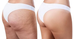 2 remedii naturiste pentru a diminua celulita
