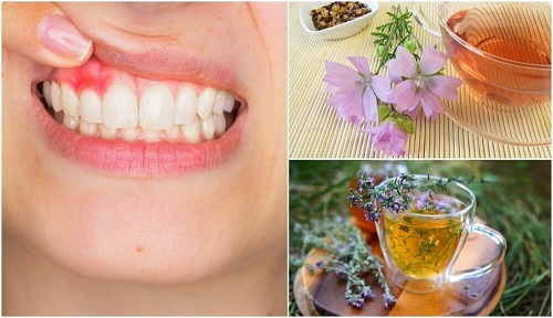 5 remedii naturiste pentru tratarea gingivitei