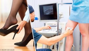 Trei remedii naturiste pentru varice