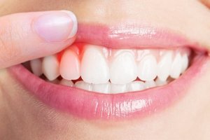 Cele mai bune 5 remedii pentru infecțiile gingivale