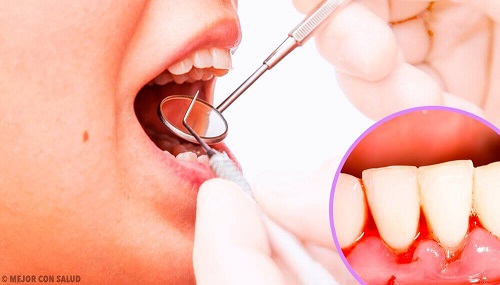 Remedii pentru infecțiile gingivale recomandate de dentist
