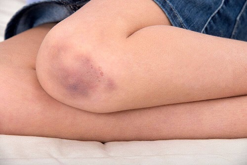 Utilizări medicinale ale vaselinei precum tratarea vânătăilor