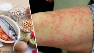 Cele mai frecvente alergii alimentare și cei mai buni înlocuitori