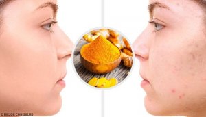 Cicatricile lăsate de acnee - măști pe bază de curcuma