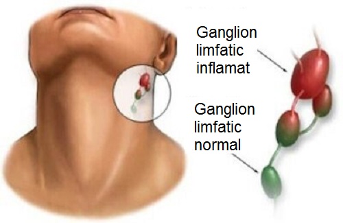 Ganglionii inflamați pe lista de semne care indică prezența plăcii în gât