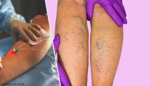 uita-te în direct despre varicoză tratamentul severității varicoase în umflarea picioarelor