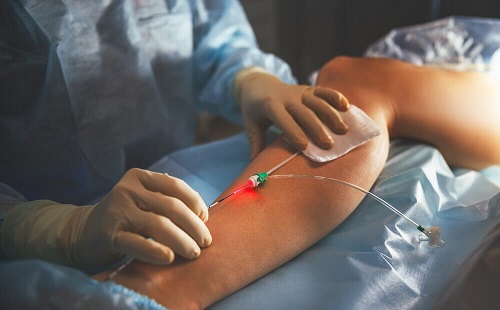 Medic explicând ce sunt varicele și cum se tratează