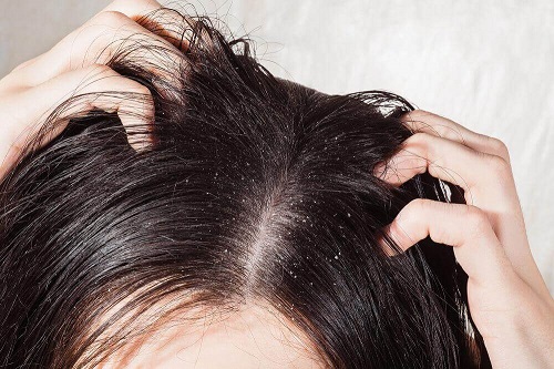 6 remedii naturale pentru micozele scalpului