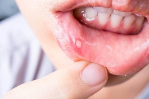 7 remedii naturale pentru vindecarea aftelor