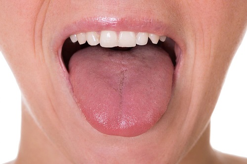 Semne care indică prezența plăcii în gât precum aspectul limbii