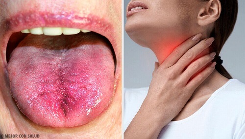 6 semne care indică prezența plăcii în gât