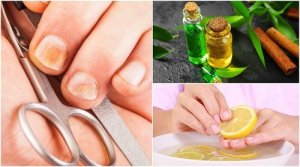 5 trucuri pentru a elimina ciuperca unghiei