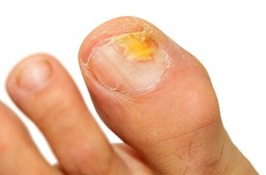 ciuperca unghiei se îndepărtează de patul unghiei remediu ieftin pentru ciuperca degetelor de la picioare și unghiilor