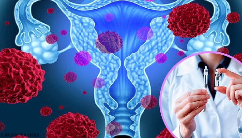 cancerul uterin cu virusul papiloma uman