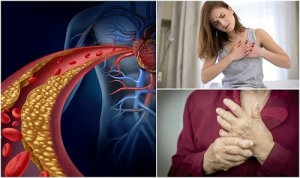 10 simptome ale nivelului crescut de colesterol