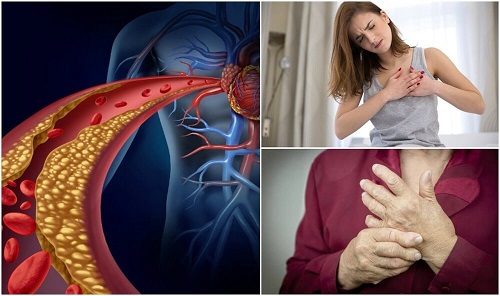 Colesterolul afectează varicoza, Diluanți pentru varice