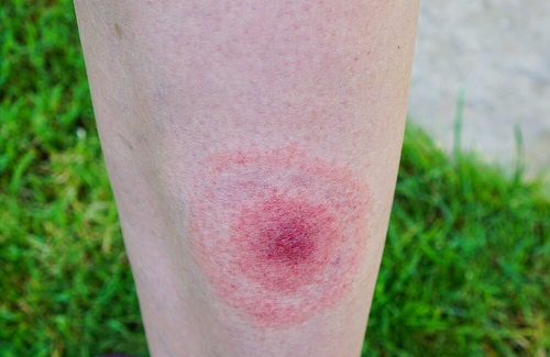 Informații despre boala Lyme și erupția pe care o provoacă