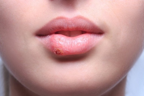 Semnale de alarmă vizibile pe față sub formă de herpes