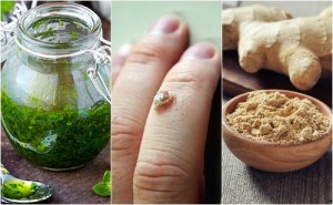 5 soluții pentru îndepărtarea negilor