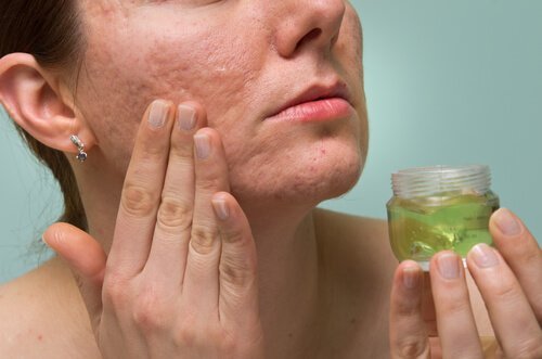 Beneficii ale gelului de aloe vera precum tratarea acneei