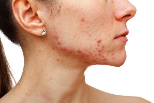 Remedii naturale cu mușețel pentru acnee