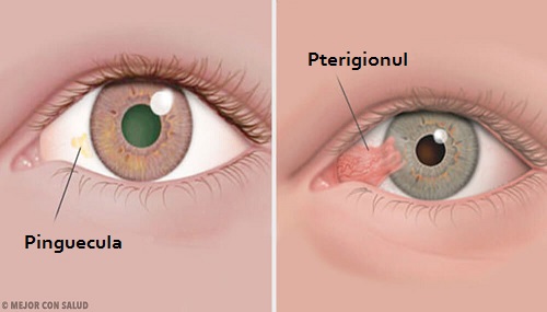 Simptomele unor boli oculare: pingueculă și pterigion